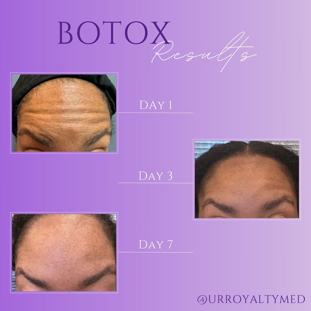 Botox Results Before and After - UR Royalty Med Spa - Cypress TX