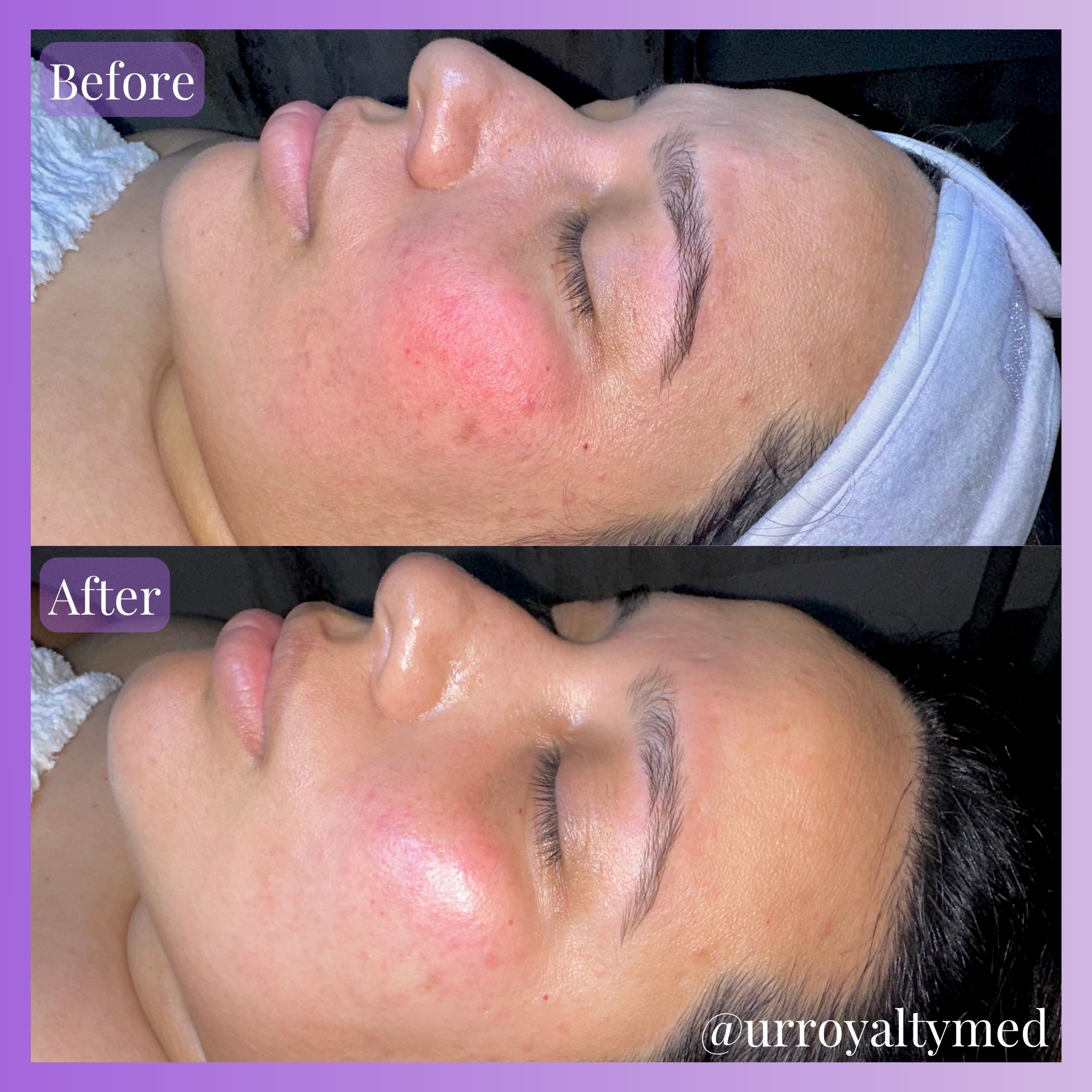 Facial Redness Before and After - UR Royalty Med Spa - Cypress TX